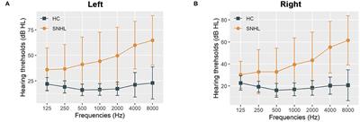 Disrupted Amygdala Connectivity Is Associated With Elevated Anxiety in Sensorineural Hearing Loss